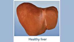 Fatty liver patients up five-fold in 2 decades Fatty liver patients up five-fold in 2 decades